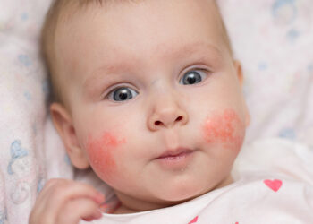 0-2 Yaş Bebeklerde Alerji Nasıl Anlaşılır? 3 Ana Belirti