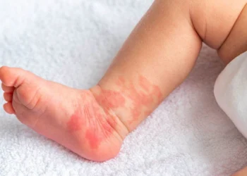 Bebeklerde Pişik Nasıl Geçer? Hızlı ve Etkili Tedavi Yöntemleri