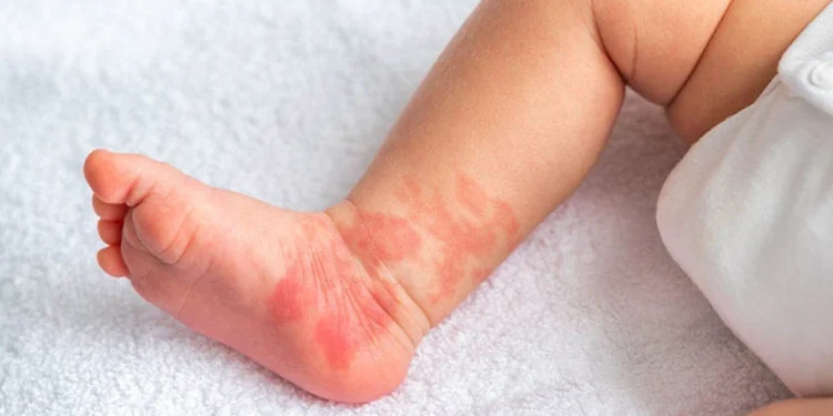 Bebeklerde Pişik Nasıl Geçer? Hızlı ve Etkili Tedavi Yöntemleri